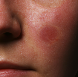 close up of female face depicting rosacea on cheek